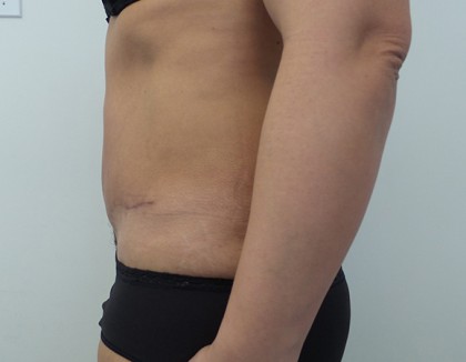 Tummy Tuck Before & After Patient #5082