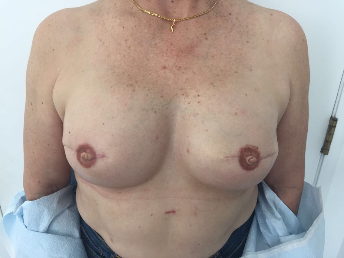 Breast Reconstruction Before & After Patient #5239