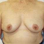 Breast Reconstruction Before & After Patient #5239