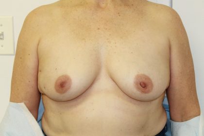 Breast Reconstruction Before & After Patient #5239