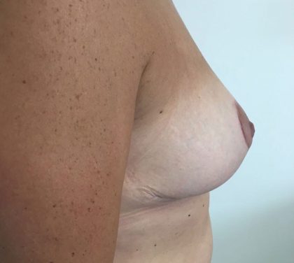 Breast Lift Before & After Patient #5248
