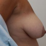 Breast Lift Before & After Patient #5248