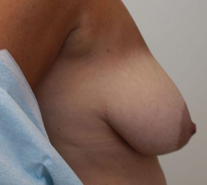 Breast Lift Before & After Patient #5248