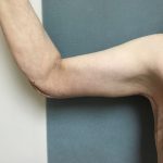 Arm Lift Before & After Patient #5253