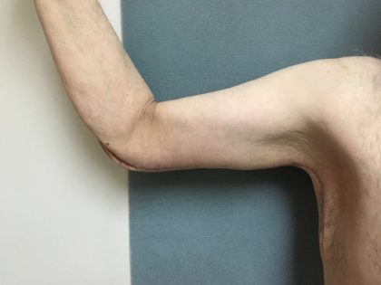 Arm Lift Before & After Patient #5253
