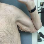 Arm Lift Before & After Patient #5253