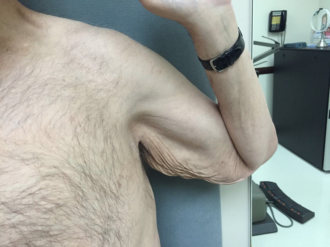 Arm Lift Before & After Patient #5253
