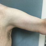 Arm Lift Before & After Patient #5253