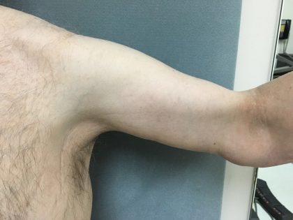 Arm Lift Before & After Patient #5253