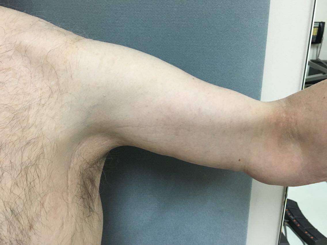 Arm Lift Before & After Patient #5253