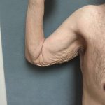 Arm Lift Before & After Patient #5253