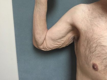 Arm Lift Before & After Patient #5253