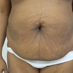 Tummy Tuck Before & After Patient #5358