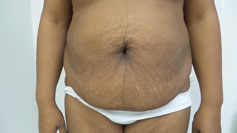 Tummy Tuck Before & After Patient #5358