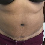 Tummy Tuck Before & After Patient #5358