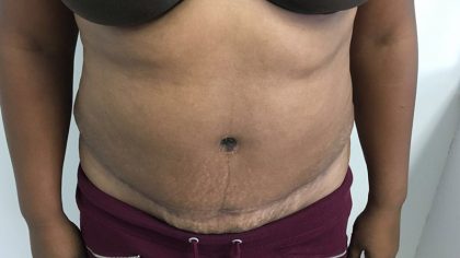 Tummy Tuck Before & After Patient #5358