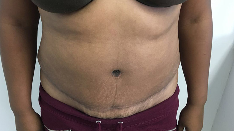 Tummy Tuck Before & After Patient #5358