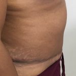 Tummy Tuck Before & After Patient #5358