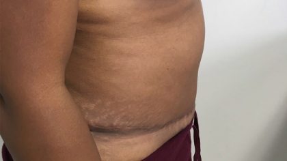 Tummy Tuck Before & After Patient #5358