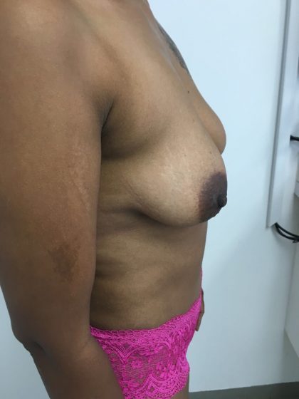 Tummy Tuck Before & After Patient #5363