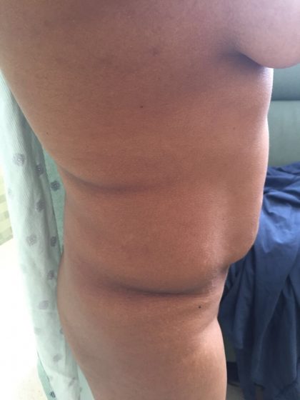 Tummy Tuck Before & After Patient #5363