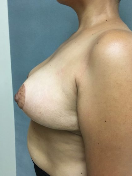 Breast Reduction Before & After Patient #5368