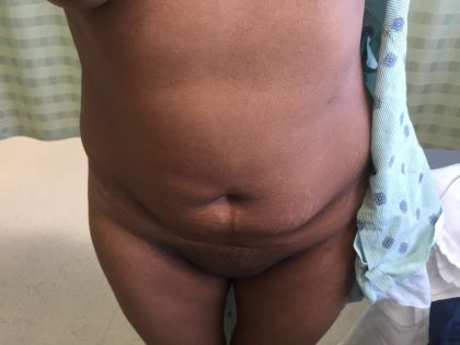 Tummy Tuck Before & After Patient #5363