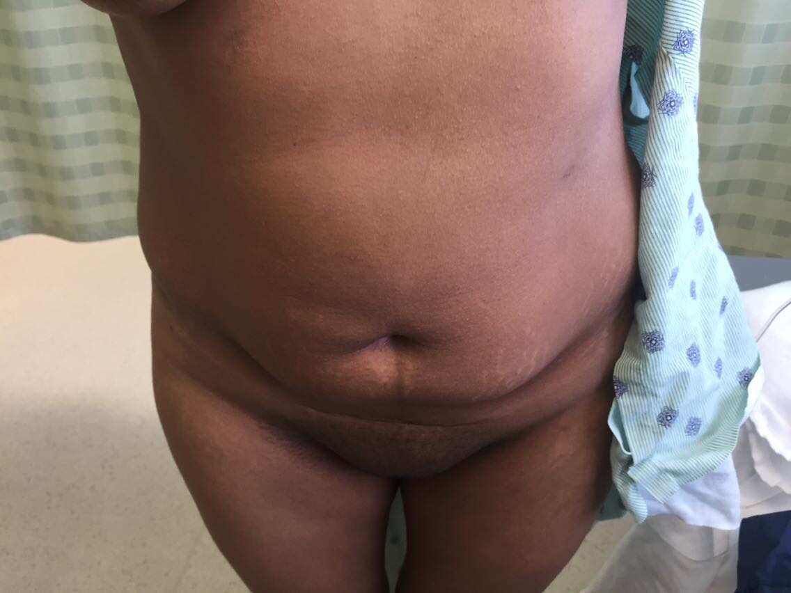 Tummy Tuck Before & After Patient #5363