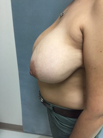 Breast Reduction Before & After Patient #5368