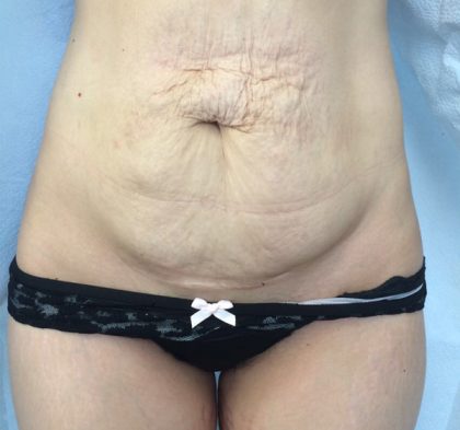 Tummy Tuck Before & After Patient #5379