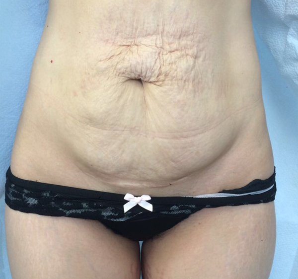 Tummy Tuck Before & After Patient #5379