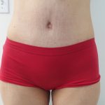 Tummy Tuck Before & After Patient #5379