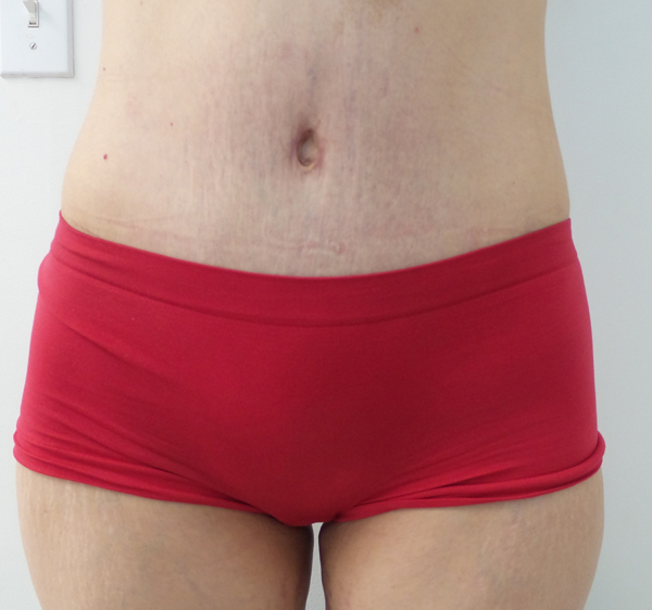 Tummy Tuck Before & After Patient #5379