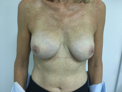 Breast Augmentation Before & After Patient #5434