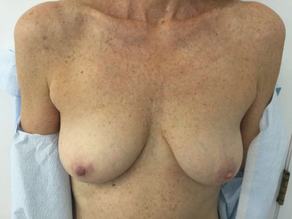 Breast Augmentation Before & After Patient #5434