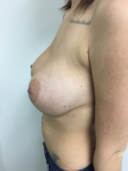 Breast Augmentation Before & After Patient #5440
