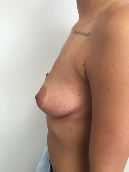 Breast Augmentation Before & After Patient #5440