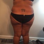 Brazilian Butt Lift Before & After Patient #5437