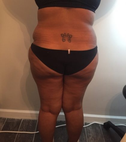 Brazilian Butt Lift Before & After Patient #5437