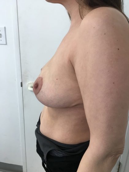 Breast Reduction Before & After Patient #5470