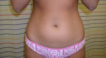 Liposuction Before & After Patient #333
