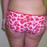 Liposuction Before & After Patient #333