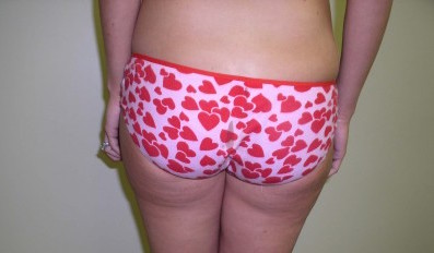 Liposuction Before & After Patient #333