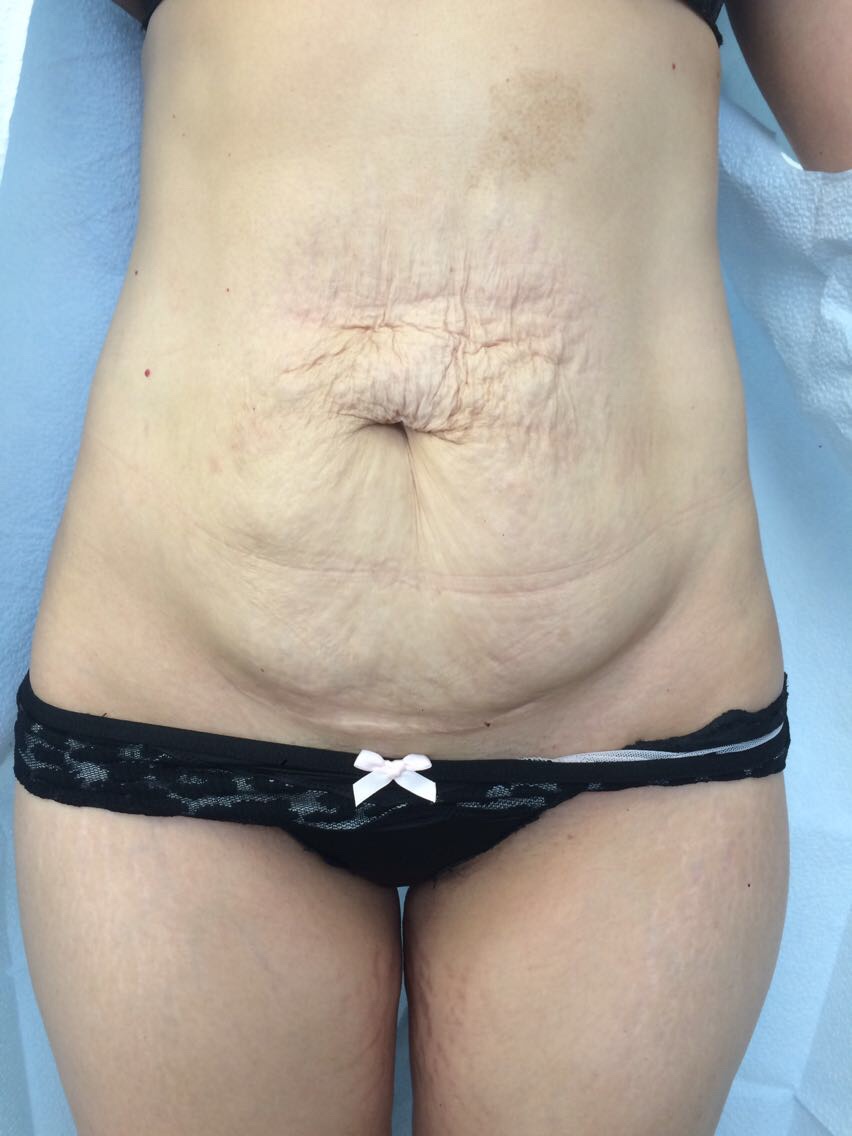 Tummy Tuck Before & After Patient #5596