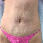 Tummy Tuck Before & After Patient #5596