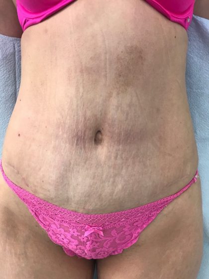 Tummy Tuck Before & After Patient #5596