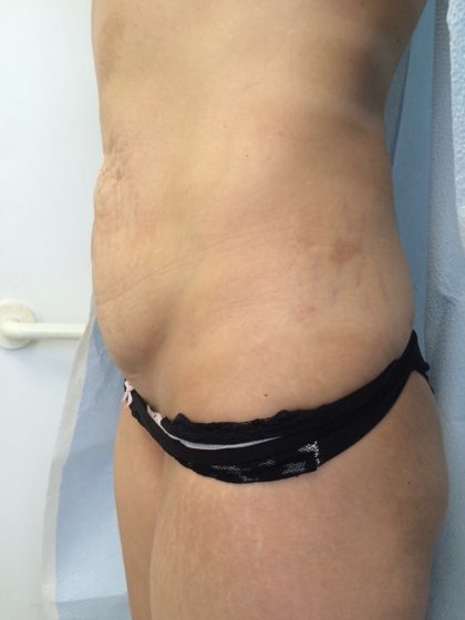 Tummy Tuck Before & After Patient #5596