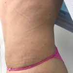 Tummy Tuck Before & After Patient #5596
