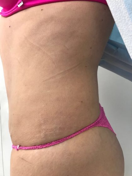 Tummy Tuck Before & After Patient #5596