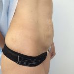 Tummy Tuck Before & After Patient #5596
